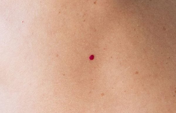 Petits points rouges sur la peau au niveau du dos