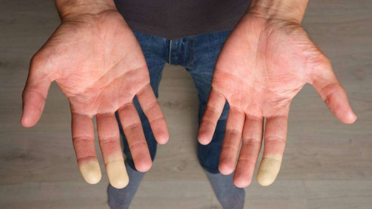 Causes du syndrome de Raynaud
