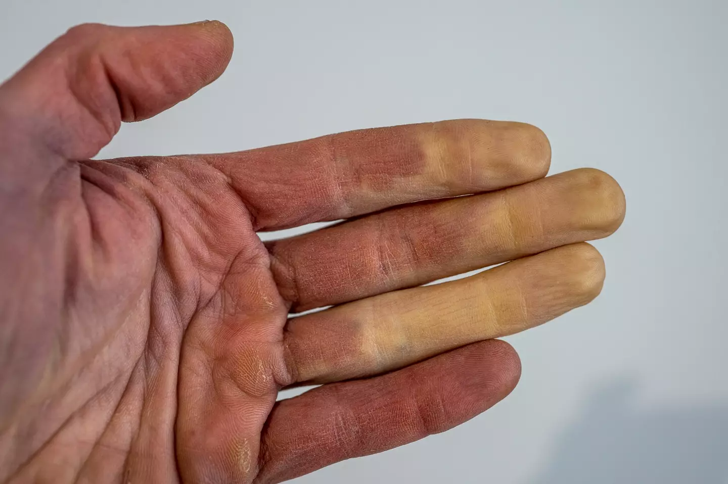Syndrome de Raynaud doigts froids