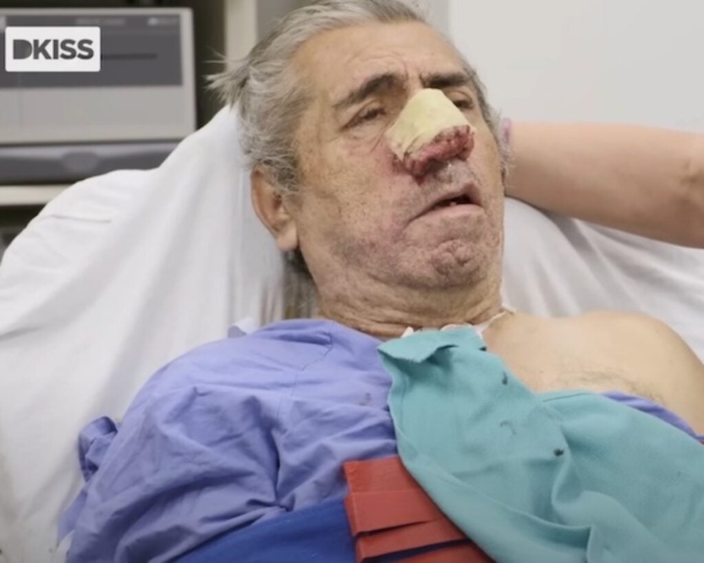 Nos Rogera wraca do normy po operacji