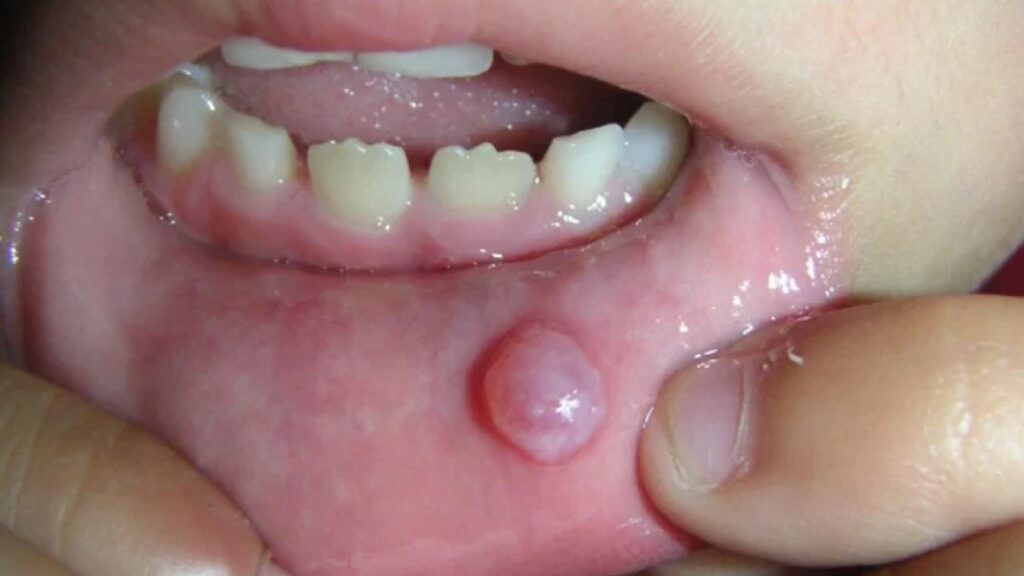 © Ces cinq signes dans la bouche peuvent révéler un problème de santé sérieux