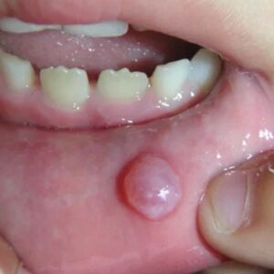 © Ces cinq signes dans la bouche peuvent révéler un problème de santé sérieux