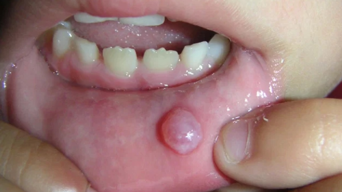 © Ces cinq signes dans la bouche peuvent révéler un problème de santé sérieux