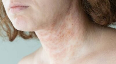 Psoriasis : une maladie inflammatoire chronique de la peau